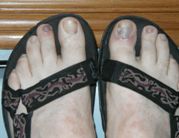 My feet after the first 100 kilometers--bandage removed from right toe.